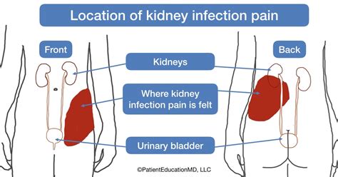 Kidney infection symptoms - PatientEducationMD