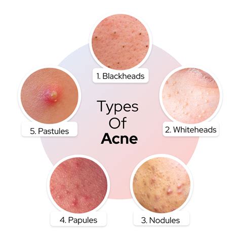 What is Acne | Types of Acne | How to treat them?