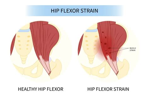 8 Strengthening Hip Flexor Exercises for Seniors