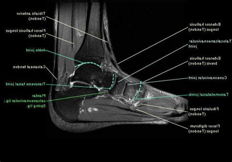 Foot Muscles Mri Anatomy Tendinous Ligamentous And Muscle Abnormalities | sexiezpix Web Porn