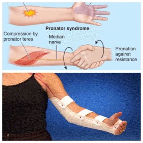 Ulnar Nerve Entrapment Surgery Procedure