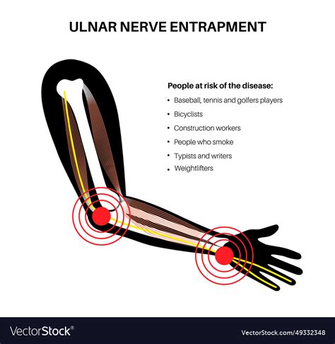 Ulnar nerve entrapment Royalty Free Vector Image