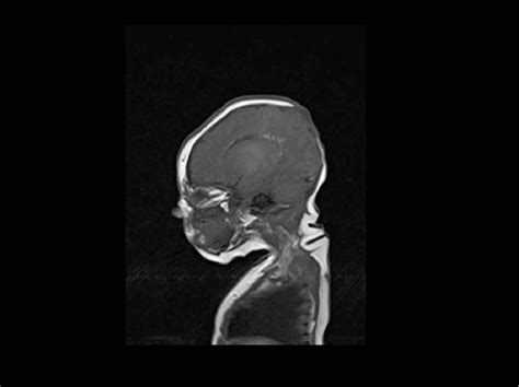 Figure 2 from Imaging features in Adams-Oliver syndrome 2 (AOS2) | Semantic Scholar