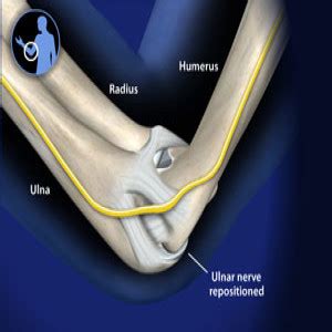 Treating Ulnar nerve transposition in Plano, Frisco, McKinney and Allen