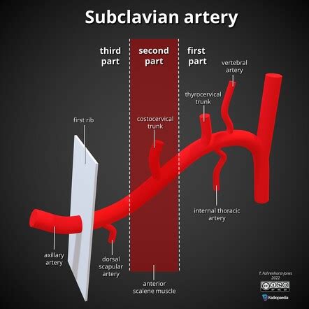 Subclavian artery branches (mnemonic) | Radiology Reference Article | Radiopaedia.org