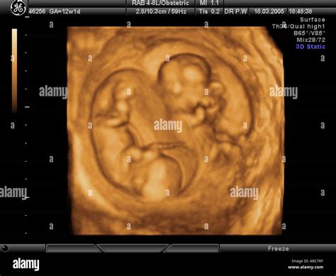 A 3D ultrasound scan of a twin pregnancy at 12 weeks gestation Stock Photo: 9151102 - Alamy