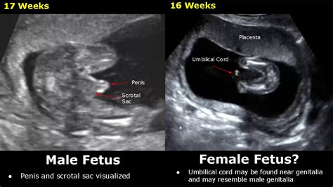 21 Weeks Pregnant Ultrasound Boy