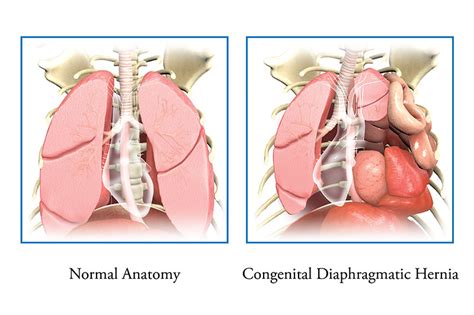 Congenital Diaphragmatic Hernia