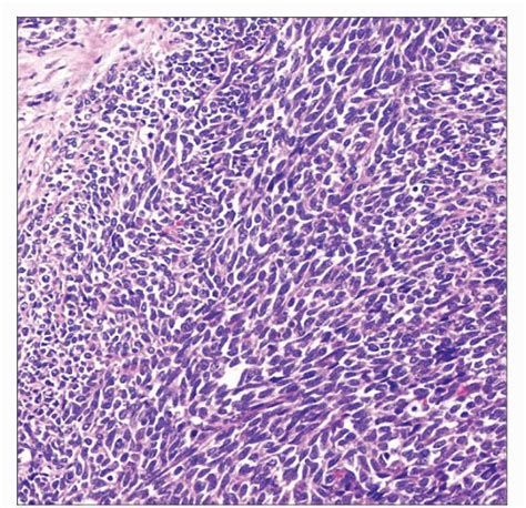 Synovial Sarcoma | Basicmedical Key