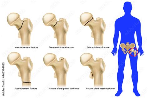 Femoral neck fracture. Types of hip fractures. Subtrochanteric, Intertrochanteric, Transcervical ...