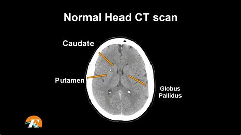 Normal Ct Brain