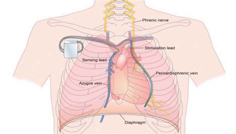 Diaphragm pacing for Central Sleep Apnoea | Adelaide Sleep