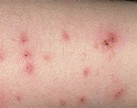 Bed Bug Bite - Pictures, Marks, Symptoms, Causes, Treatment