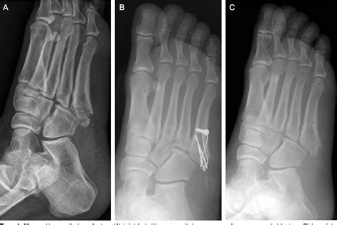 Figure 1 from Treatment of Fifth Metatarsal Base Fracture Using Tension Band Wiring | Semantic ...