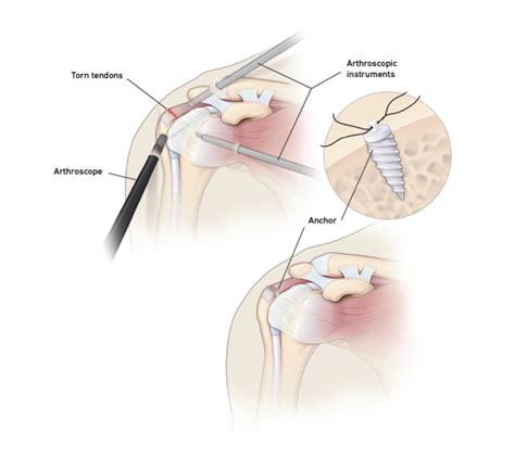 Rotator Cuff Surgery Recovery Timeline - change comin