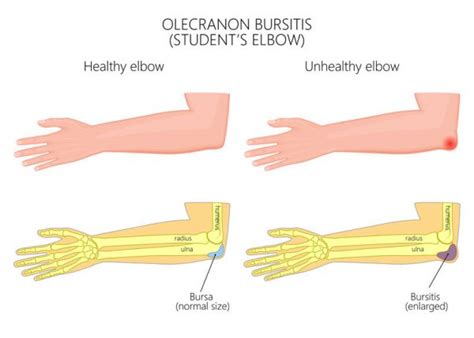 What Exactly Is Elbow (Olecranon) Bursitis? - SimplyJnJ