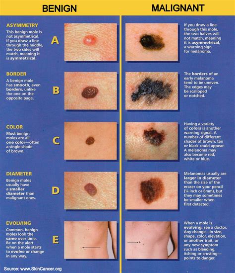 Melanoma Skin Moles