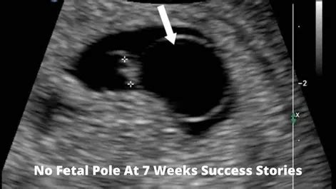 What Is A Fetal Pole?