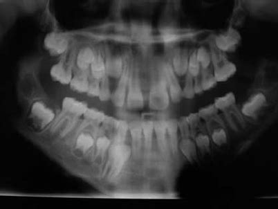 Case 2. Panoramic X-ray view showing taurodontism affecting 2.6 and... | Download Scientific Diagram