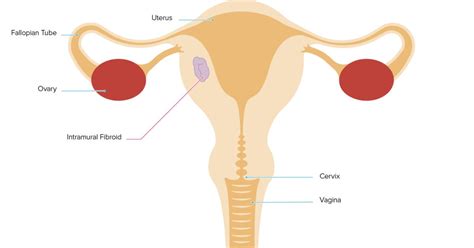 Intramural Fibroid: Symptoms, Diagnosis, and Treatment