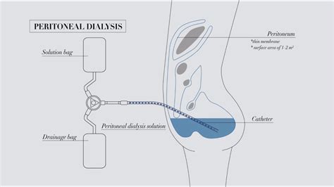 Peritoneal Dialysis Catheter Types