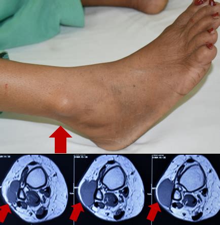 Soft Tissue Sarcoma Treatment in India | Cure Bone Cancer