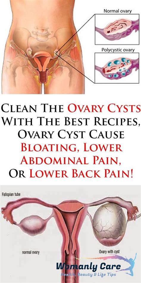 Pin on Cyst on ovary