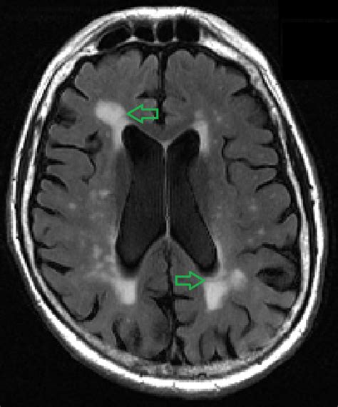 ‘White Matter Lesion’ Mapping Tool Identifies Early Signs of Dementia | NYU Langone News