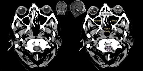 Head and spine anatomy - Radiology Cafe