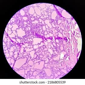 Synovial Sarcoma Histology Image Analyzed By Stock Photo 2186805539 | Shutterstock