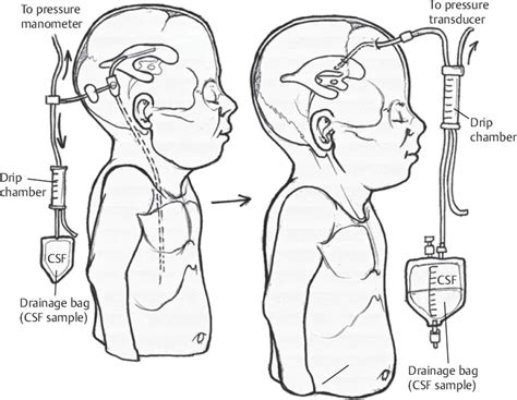 Shunt Externalization | Neupsy Key