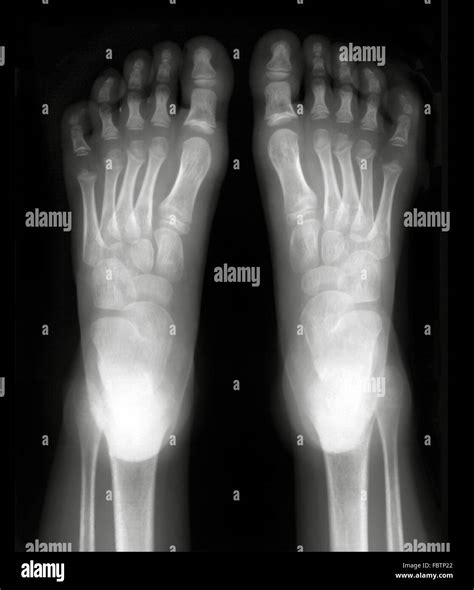 Foot Xray High Resolution Stock Photography and Images - Alamy