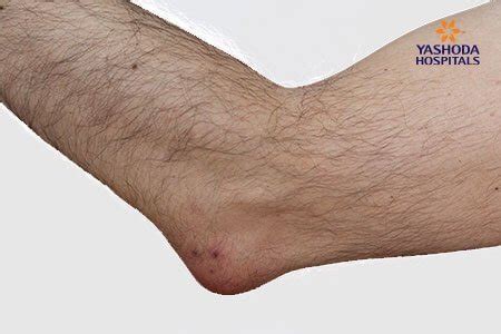 Elbow (Olecranon) Bursitis: What is Elbow (Olecranon) Bursitis, its Causes?