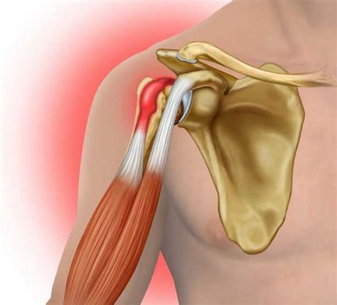 Shoulder Bicep Tendon Tear Mri