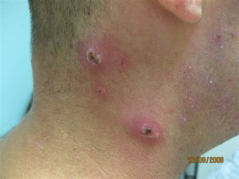 Folliculitis and boils - DERMBOARD