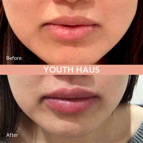 Collagen Injection Lips Before And After Photos - Infoupdate.org