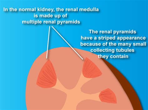 Medullary-sponge-kidney illustration 1 in 2020 | Medullary sponge kidney, Kidney treatment, Kidney