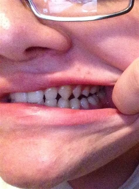 Why "My teeth are unusually sharp"? : r/biology