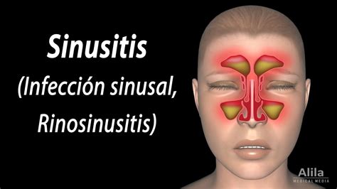 Sinusitis, Animación. Alila Medical Media Español. - YouTube