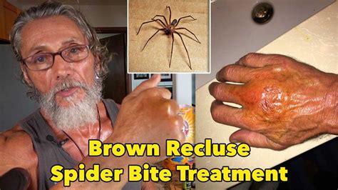 Brown Recluse Spider Bite Treatment - Earther Academy