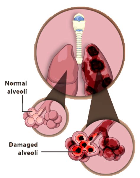 Describe disorders of the respiratory system.