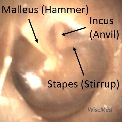 Hammer, Anvil & Stirrup by otoscopy. Bones of the middle ear. - WiscMed