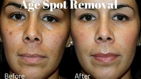 Age Spots On Face Treatment