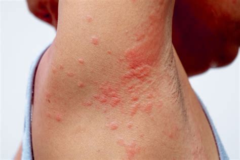 What Causes a Skin Rash? What is Contact Dermatitis? - Adv