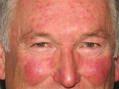 Rosacea - Causes, Symptoms, Cream, Diet & Rosacea Treatment