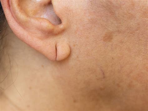 Ear Lobe Repair Reconstruction | GMC Cosmedical