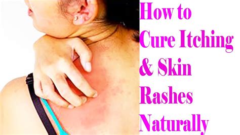 3 Most Effective And Easy Home Remedies For Itchy Skin | How to Cure Itching & Skin Rashes ...