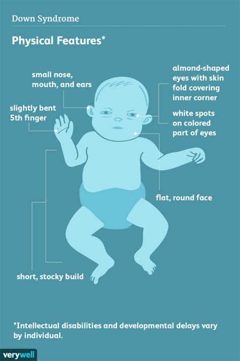 Physical and Health Features of Down Syndrome