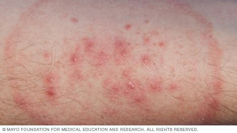 Slide show: Common skin rashes - Mayo Clinic