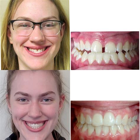 Braces Under Bite Adult Before And After